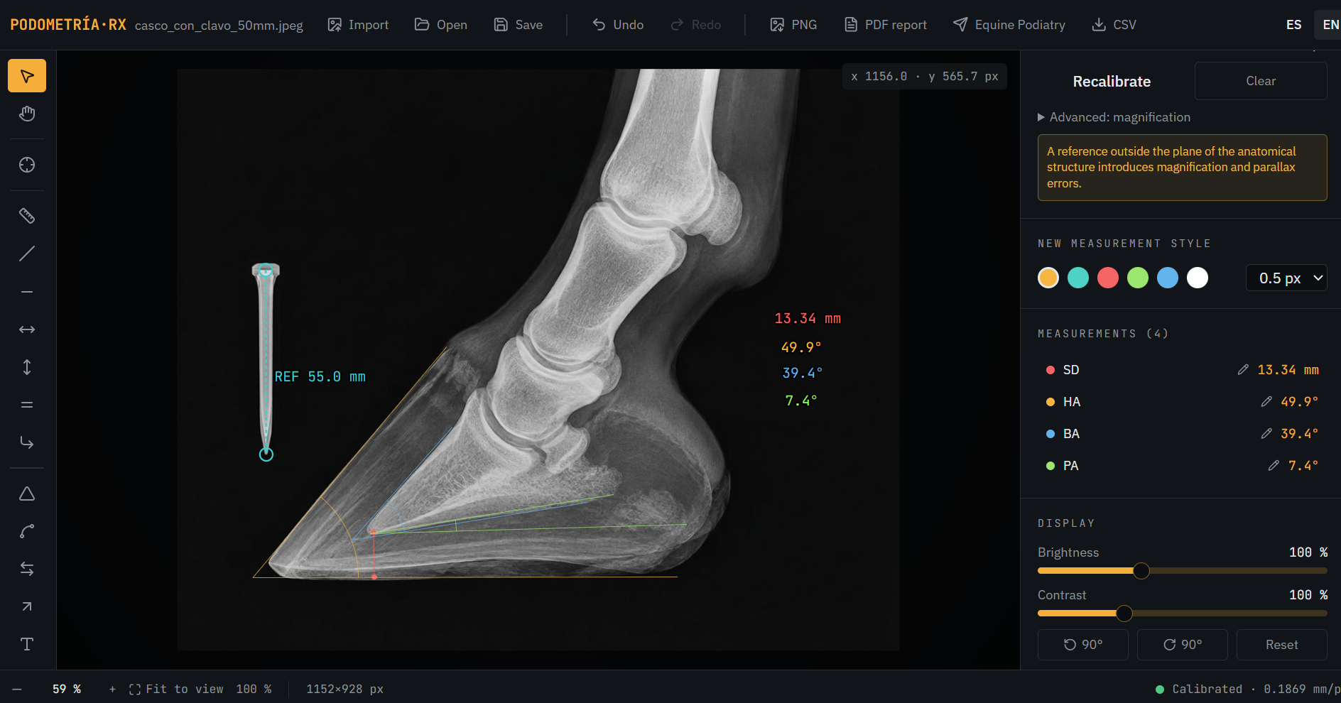App screenshot with the calibrated radiograph and the measured angles